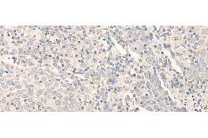 Immunohistochemistry of paraffin-embedded Human cervical cancer tissue using RADIL Polyclonal Antibody at dilution of 1:40(x200) (Radil 抗体)