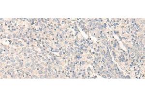 Immunohistochemistry of paraffin-embedded Human cervical cancer tissue using RADIL Polyclonal Antibody at dilution of 1:40(x200) (Radil 抗体)