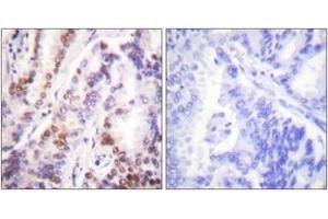Immunohistochemistry analysis of paraffin-embedded human lung carcinoma tissue, using HDAC9 Antibody. (HDAC9 抗体  (AA 1017-1066))