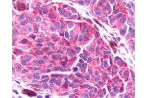 Anti-BAI3 antibody IHC of human Skin, Melanoma. (BAI3 抗体  (Cytoplasmic Domain))