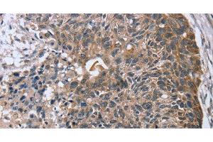 Immunohistochemistry of paraffin-embedded Human esophagus cancer using RASSF7 Polyclonal Antibody at dilution of 1:45 (RASSF7 抗体)