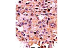Formalin-fixed and paraffin-embedded human cancer tissue reacted with the primary antibody, which was peroxidase-conjugated to the secondary antibody, followed by AEC staining. (CAN 抗体  (N-Term))