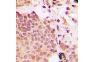 Immunohistochemical analysis of G3BP1 (pS232) staining in human breast cancer formalin fixed paraffin embedded tissue section. (G3BP1 抗体  (pSer232))