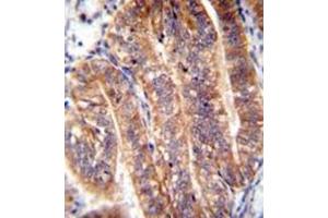 Immunohistochemistry analysis in formalin fixed and paraffin embedded human uterus tissue reacted with NUMB Antibody (N-term) followed by peroxidase conjugation of the secondary antibody and DAB staining. (NUMB 抗体  (N-Term))