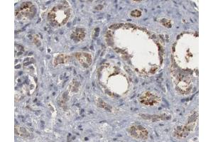 1/50 dilution staining Caspase 9 in human lung carcinoma by Immunohistochemistry (Caspase 9 抗体  (Cleaved-Asp330))