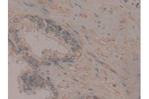 Detection of Flt3 in Human Prostate Tissue using Polyclonal Antibody to FMS Like Tyrosine Kinase 3 (Flt3) (FLT3 抗体  (AA 334-543))
