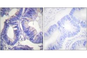 Immunohistochemistry analysis of paraffin-embedded human colon carcinoma tissue, using NCK2 Antibody. (NCK2 抗体  (AA 331-380))