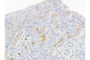 ABIN6255507 and ABIN6267620 at 1/100 staining human tongue carcinoma by IHC-P. (Caldesmon 抗体  (pSer789))