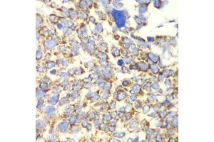 Immunohistochemistry of paraffin-embedded human esophageal cancer using GLUD2 antibody. (GLUD2 抗体)