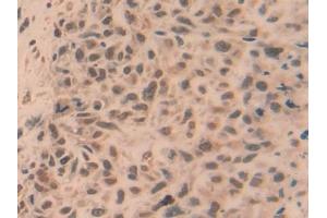 Detection of TRAF5 in Human Lung cancer Tissue using Polyclonal Antibody to TNF Receptor Associated Factor 5 (TRAF5) (TRAF5 抗体  (AA 181-437))