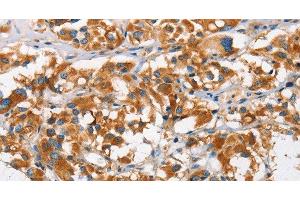 Immunohistochemistry of paraffin-embedded Human thyroid cancer using DKK3 Polyclonal Antibody at dilution of 1:50 (DKK3 抗体)
