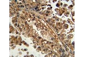 ABCG1 antibody immunohistochemistry analysis in formalin fixed and paraffin embedded human lung carcinoma.