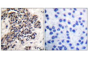 Immunohistochemical analysis of paraffin-embedded human breast carcinoma tissue, using HSP90B (phospho-Ser254) antibody. (HSP90AB1 抗体  (pSer254))