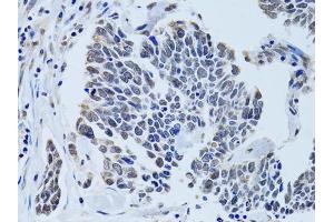 Immunohistochemistry of paraffin-embedded human lung cancer using SIN3A antibody (ABIN6293567) at dilution of 1:100 (40x lens).