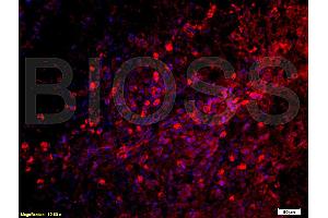 Formalin-fixed and paraffin embedded: Human laryngeal carcinoma labeled with Anti-C5a Polyclonal Antibody (ABIN727875), Unconjugated at 1:200, followed by conjugation to the secondary antibody was Goat Anti-Rabbit IgG, PE conjugated at 1:200 for 40 minutes at 37°C (C5 抗体  (AA 701-755))