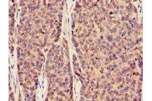 Immunohistochemistry of paraffin-embedded human ovarian cancer using ABIN7170002 at dilution of 1:100 (GLUT1 抗体  (AA 263-458))