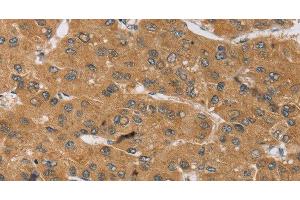 Immunohistochemistry of paraffin-embedded Human liver cancer tissue using KCNJ15 Polyclonal Antibody at dilution 1:40 (KCNJ15 抗体)