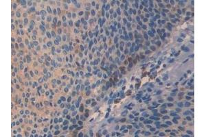 Detection of Slit3 in Human Skin cancer Tissue using Polyclonal Antibody to Slit Homolog 3 (Slit3)