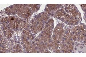 ABIN6273973 at 1/100 staining Human liver cancer tissue by IHC-P. (OR1L3 抗体  (C-Term))