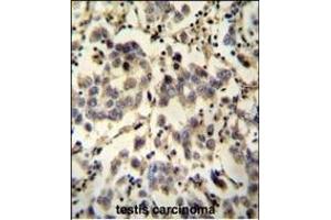 C6orf58 antibody (Center) (ABIN653979 and ABIN2843925) immunohistochemistry analysis in formalin fixed and paraffin embedded human testis carcinoma followed by peroxidase conjugation of the secondary antibody and DAB staining. (C6ORF58 抗体  (AA 205-233))
