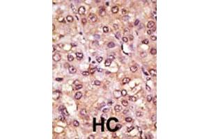Formalin-fixed and paraffin-embedded human hepatocellular carcinoma tissue reacted with ASCL1 polyclonal antibody , which was peroxidase-conjugated to the secondary antibody, followed by AEC staining.