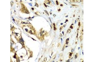 Immunohistochemistry of paraffin-embedded Human liver cancer using TMOD4 Polyclonal Antibody at dilution of 1:100 (40x lens). (Tropomodulin 4 抗体)