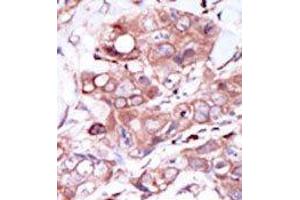Formalin-fixed and paraffin-embedded human cancer tissue reacted with the primary antibody, which was peroxidase-conjugated to the secondary antibody, followed by DAB staining. (ERBB4 抗体  (C-Term))
