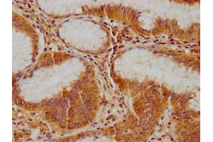 IHC image of ABIN7139891 diluted at 1:100 and staining in paraffin-embedded human gastric cancer performed on a Leica BondTM system. (IFNA5 抗体  (AA 52-73))