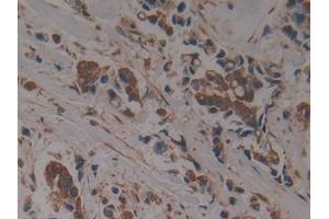 DAB staining on IHC-P; Samples: Human Breast cancer Tissue