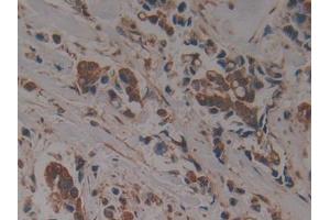 DAB staining on IHC-P; Samples: Human Breast cancer Tissue (PSMC6 抗体  (AA 2-403))