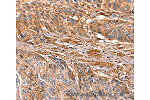 Immunohistochemistry of Human esophagus cancer using LGALS1 Polyclonal Antibody at dilution of 1:25