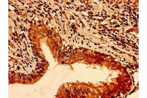 Immunohistochemistry of paraffin-embedded human lung cancer using ABIN7172475 at dilution of 1:100