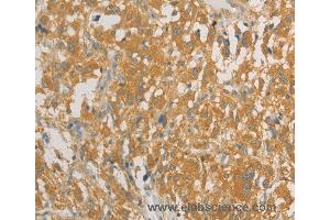 Immunohistochemistry of Human liver cancer using PRPSAP1 Polyclonal Antibody at dilution of 1:80 (PRPSAP1 抗体)