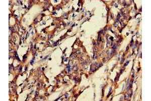 Immunohistochemistry of paraffin-embedded human gastric cancer using ABIN7153675 at dilution of 1:100 (Gastrin-Releasing Peptide 抗体  (AA 31-98))