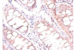 Immunohistochemistry of paraffin-embedded human colon cancer using ABIN7147238 at dilution of 1:100 (CDKN2AIPNL 抗体  (N-Term))