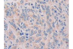 DAB staining on IHC-P; Samples: Human Prostate cancer Tissue (IL-37 抗体  (AA 46-218))