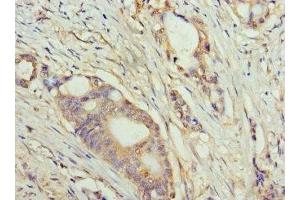 Immunohistochemistry of paraffin-embedded human colon cancer using ABIN7159633 at dilution of 1:100