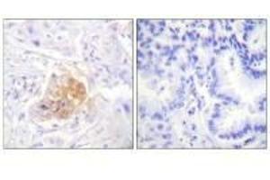 Immunohistochemistry analysis of paraffin-embedded human lung carcinoma tissue using IL-2Rβ/CD122 (Ab-364) antibody. (IL2 Receptor beta 抗体  (Tyr364))