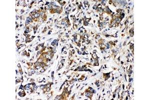 IHC-P: TRPV2 antibody testing of human intestine cancer tissue