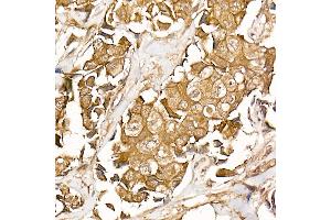 Immunohistochemistry of paraffin-embedded human breast cancer using β-Catenin Rabbit mAb (ABIN7266138) at dilution of 1:50 (40x lens). (CTNNB1 抗体)