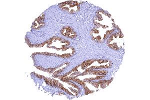 Strong membranous CD38 staining of prostatic epithelial cells (Recombinant CD38 抗体  (AA 190-310))