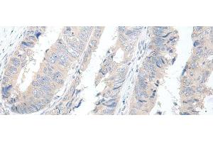 Immunohistochemistry of paraffin-embedded Human colorectal cancer tissue using GBA2 Polyclonal Antibody at dilution of 1:55(x200) (GBA2 抗体)