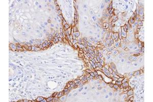 IHC-P Image Immunohistochemical analysis of paraffin-embedded SCC15 xenograft, using CD98, antibody at 1:100 dilution. (SLC3A2 抗体)