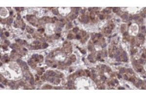 ABIN6273910 at 1/100 staining Human liver cancer tissue by IHC-P. (SSTR5 抗体  (Internal Region))