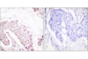 Immunohistochemistry analysis of paraffin-embedded human breast carcinoma, using Akt (Phospho-Ser124) Antibody. (AKT1 抗体  (pSer124))