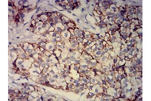 Immunohistochemical analysis of paraffin-embedded bladder cancer tissues using CD239 mouse mAb with DAB staining. (BCAM 抗体  (AA 32-197))