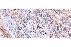 Immunohistochemistry of paraffin-embedded Human cervical cancer tissue using FUCA2 Polyclonal Antibody at dilution of 1:70(x200) (FUCA2 抗体)