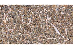 Immunohistochemistry of paraffin-embedded Human cervical cancer using PTPN12 Polyclonal Antibody at dilution of 1:45 (PTPN12 抗体)