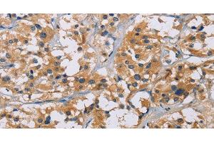 Immunohistochemistry of paraffin-embedded Human thyroid cancer tissue using NME5 Polyclonal Antibody at dilution 1:50 (NME5 抗体)