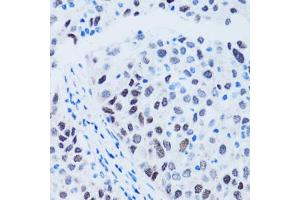 Immunohistochemistry of paraffin-embedded human lung cancer using TP53 antibody (ABIN4905469) at dilution of 1:100 (40x lens). (p53 抗体)